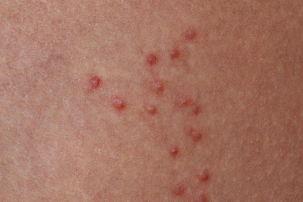 Ticks allergic